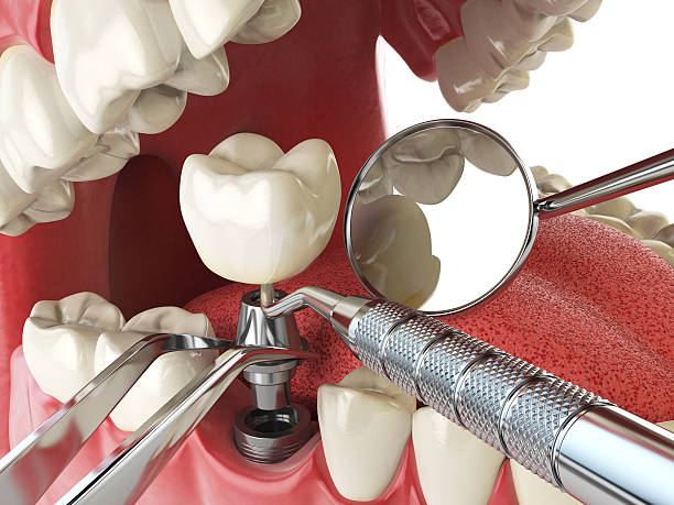 Best Emergency Tooth Extraction in Baudette, MN